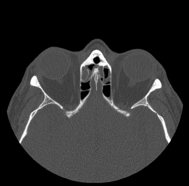 File:Acute sinusitis (Radiopaedia 23161-23215 Axial bone window 52).jpg