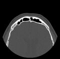 Acute sinusitis (Radiopaedia 23161-23215 Axial bone window 72).jpg
