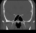 Acute sinusitis (Radiopaedia 23161-23215 Coronal bone window 49).jpg