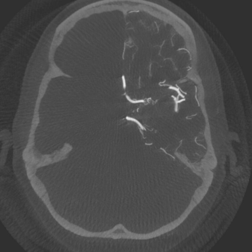 Acute subarachnoid hemorrhage and accessory anterior cerebral artery (Radiopaedia 69231-79010 C 23).jpg