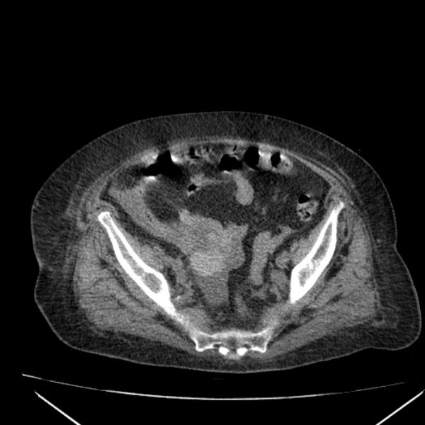 File:Acute tubular necrosis (Radiopaedia 28077-28334 Axial non-contrast 56).jpg
