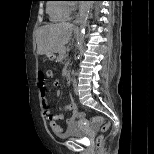 File:Acute tubular necrosis (Radiopaedia 28077-28334 H 50).jpg