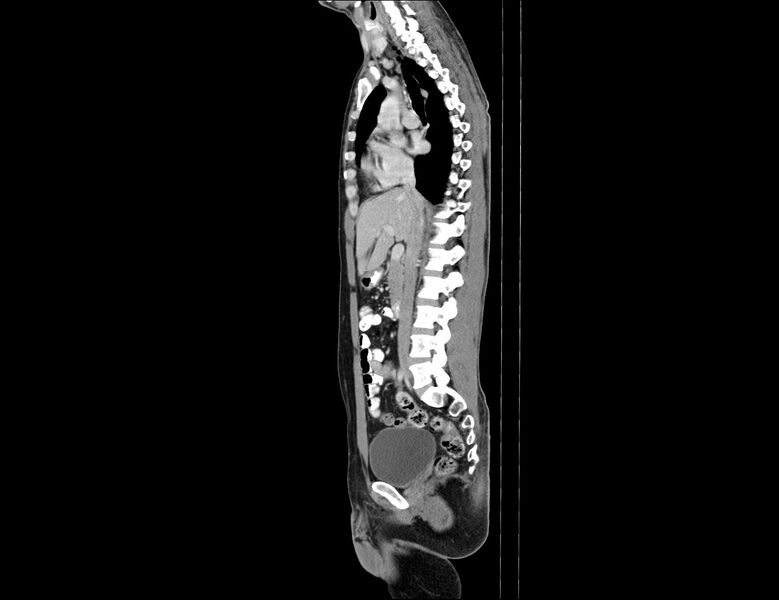 File:Addison disease (Radiopaedia 49318-54412 Sagittal C+ portal venous phase 39).jpg