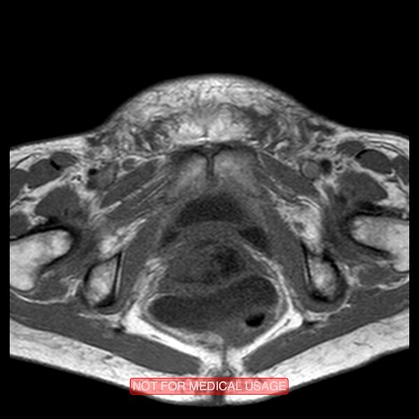 File:Adenocarcinoma of the cervix (Radiopaedia 28373-28615 Axial T1 5).jpg