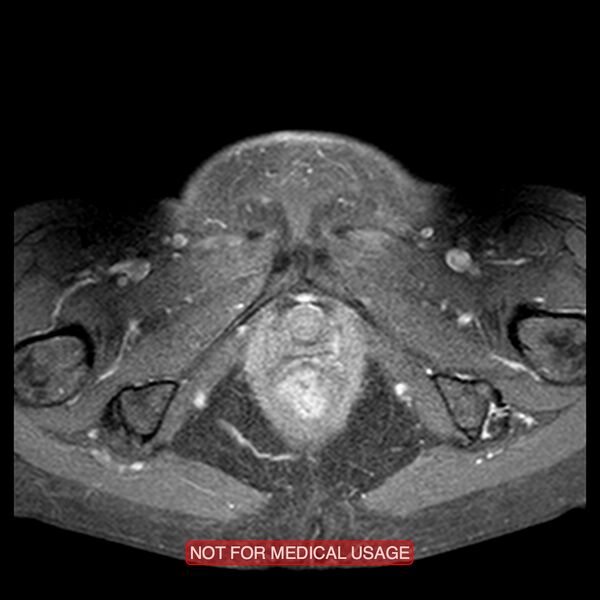File:Adenocarcinoma of the cervix (Radiopaedia 28373-28615 Axial T1 C+ fat sat 1).jpg