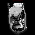 Adenocarcinoma of the colon (Radiopaedia 8191-9039 Coronal liver window 11).jpg