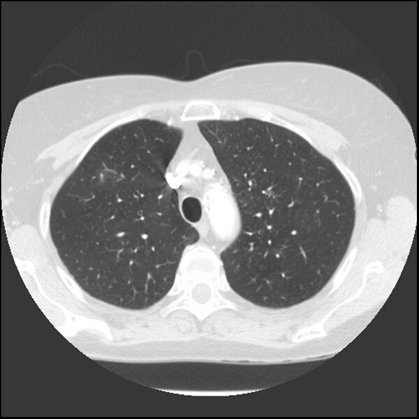 File:Adenocarcinoma of the lung (Radiopaedia 41015-43755 Axial lung window 31).jpg