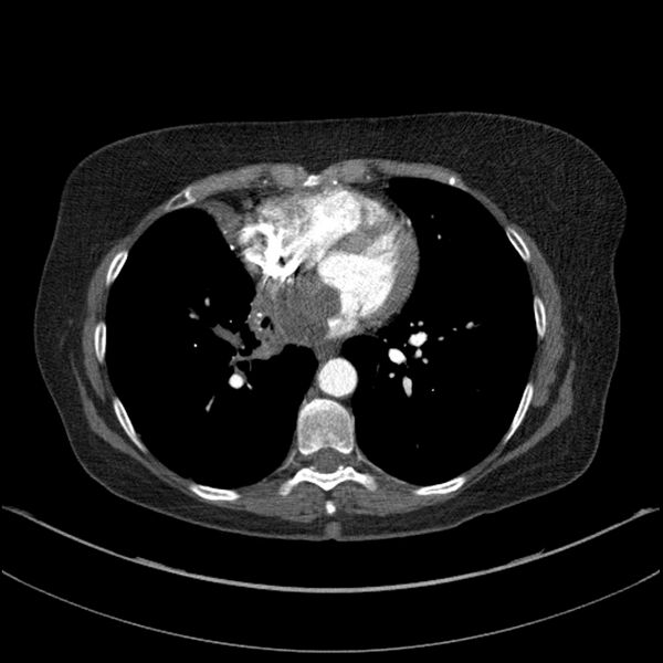 File:Adenocarcinoma of the lung (Radiopaedia 44205-47803 Axial C+ portal venous phase 54).jpg