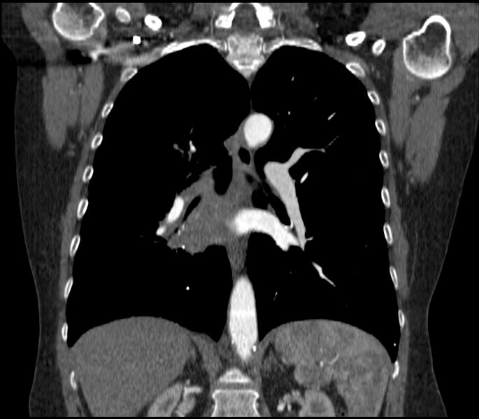 File:Adenocarcinoma of the lung (Radiopaedia 44205-47803 Coronal C+ portal venous phase 55).jpg