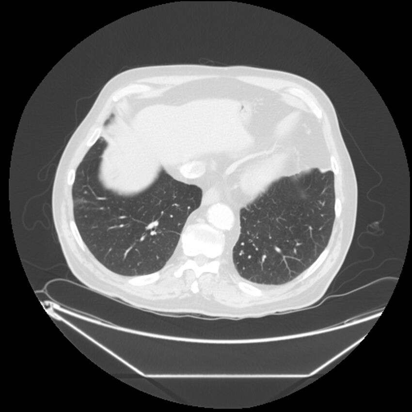 Adenocarcinoma of the lung (Radiopaedia 44876-48759 Axial lung window 63).jpg