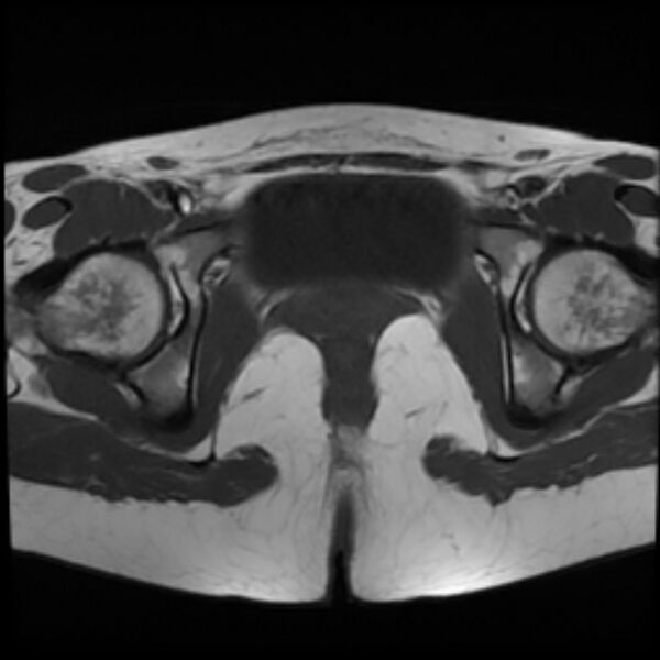 File:Adenomyosis within a septate uterus (Radiopaedia 69963-79981 Axial T1 23).jpg