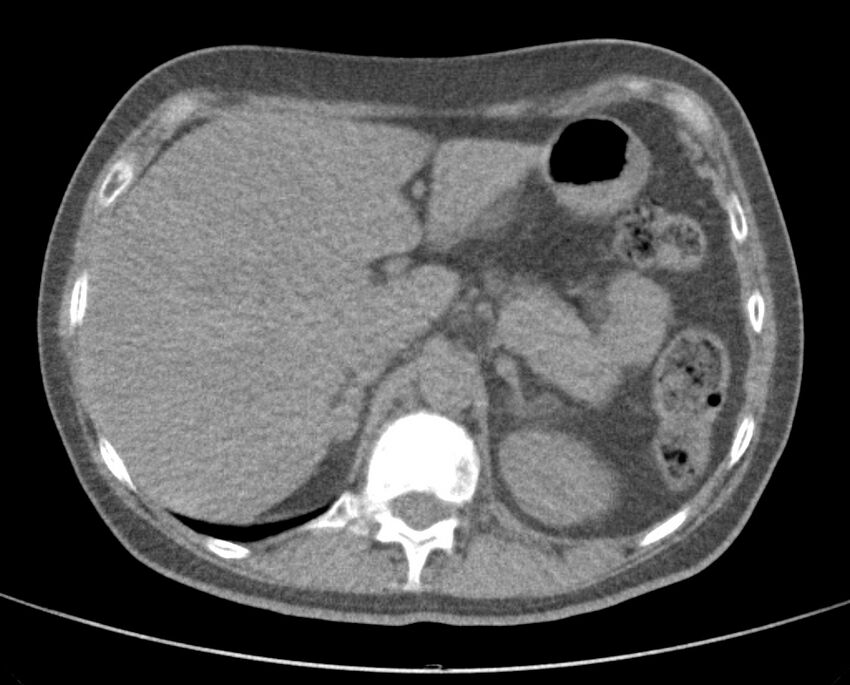Adenosquamous lung carcinoma (Radiopaedia 22035-22030 non-contrast 59).jpg