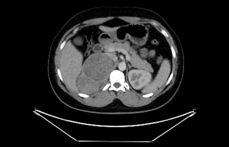 File:Adrenocortical carcinoma (Radiopaedia 80134-93438 Axial C+ portal venous phase 41).jpg