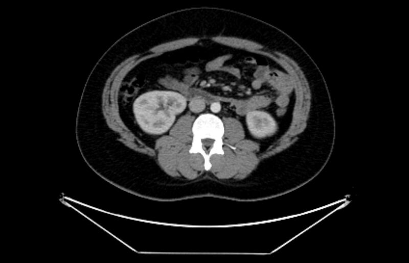 File:Adrenocortical carcinoma (Radiopaedia 80134-93438 Axial C+ portal venous phase 65).jpg