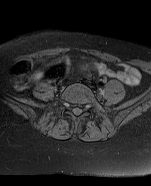 File:Adult granulosa cell tumor of the ovary (Radiopaedia 71581-81950 Axial T1 fat sat 4).jpg