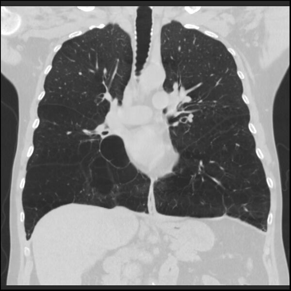 File:Alpha-1-antitrypsin deficiency (Radiopaedia 40993-43722 Coronal lung window 48).jpg