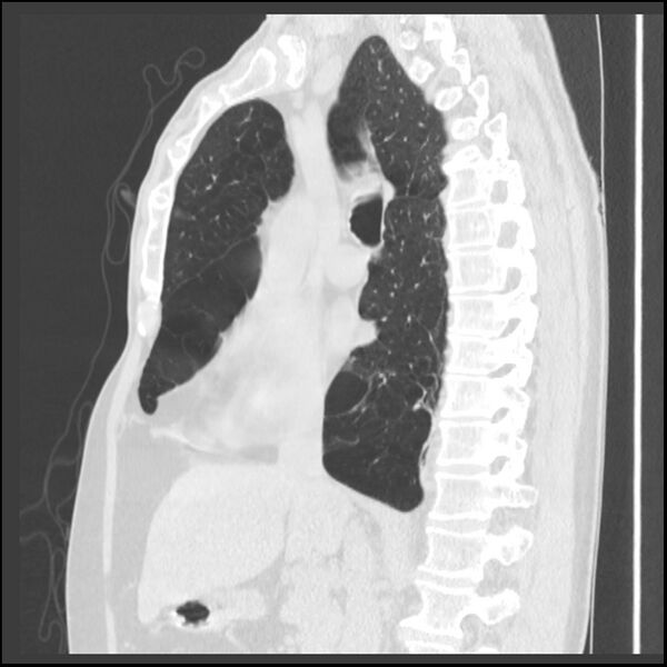 File:Alpha-1-antitrypsin deficiency (Radiopaedia 40993-43722 Sagittal lung window 148).jpg