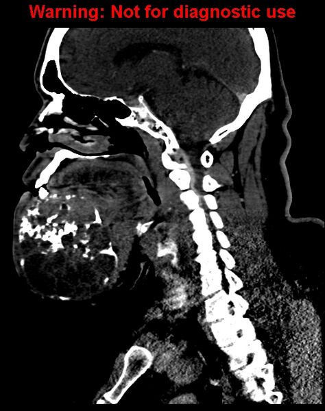 File:Ameloblastoma (Radiopaedia 33126-34164 F 34).jpg