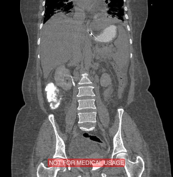 File:Amoebic enterocolitis with liver abscess (Radiopaedia 35100-36609 B 117).jpg