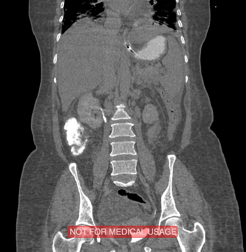 Amoebic enterocolitis with liver abscess (Radiopaedia 35100-36609 B 117).jpg