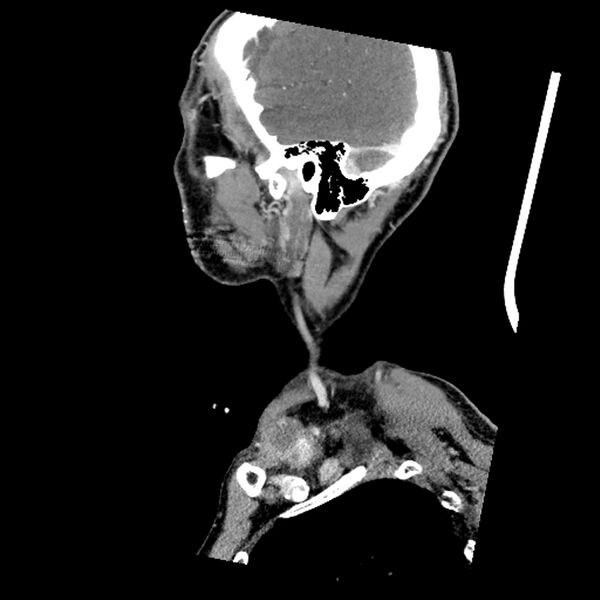 File:Anaplastic thyroid carcinoma (Radiopaedia 79087-92034 C 18).jpg
