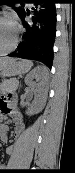 File:Aneurysmal bone cyst T11 (Radiopaedia 29294-29721 E 8).jpg