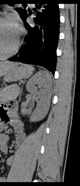 File:Aneurysmal bone cyst T11 (Radiopaedia 29294-29721 E 9).jpg