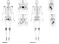 Aneurysmal bone cyst of ischium (Radiopaedia 25957-26095 A 1).png