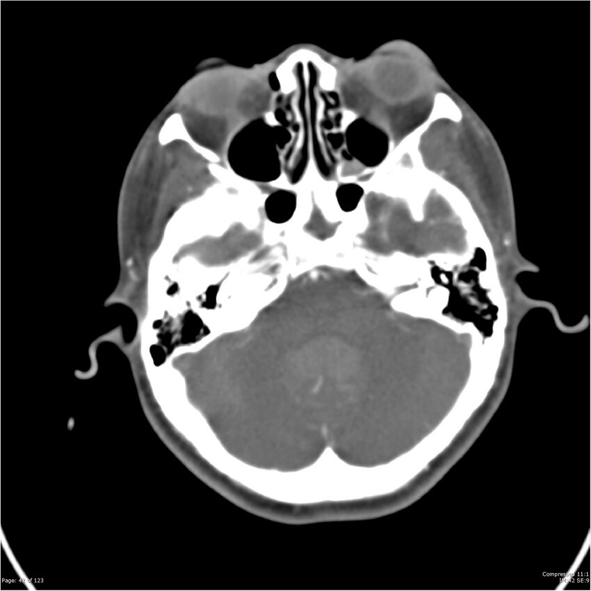 Aneurysmal subarachnoid hemorrhage and Moya Moya disease (Radiopaedia 34306-35593 Axial CT COW 42).jpg