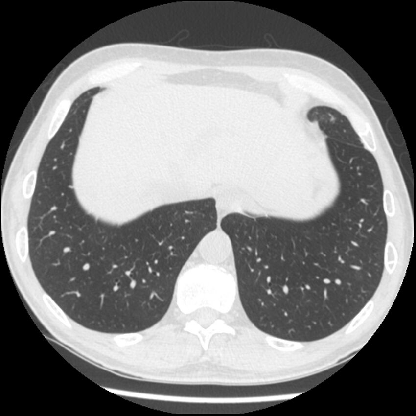 Angioinvasive aspergillosis (Radiopaedia 43957-47466 Axial lung window 56).jpg
