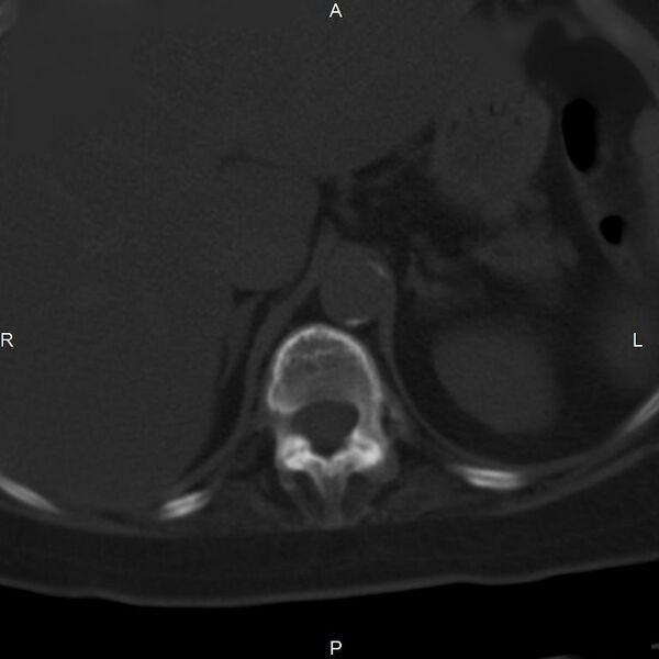 File:Ankylosing spondylitis (Radiopaedia 8748-9556 Axial bone window 14).jpg