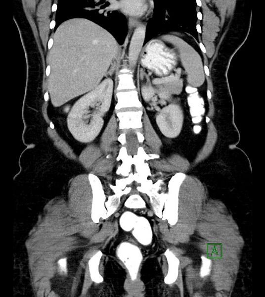 File:Anterior abdominal wall CSF pseudocyst (CSFoma) (Radiopaedia 79453-92571 B 38).jpg