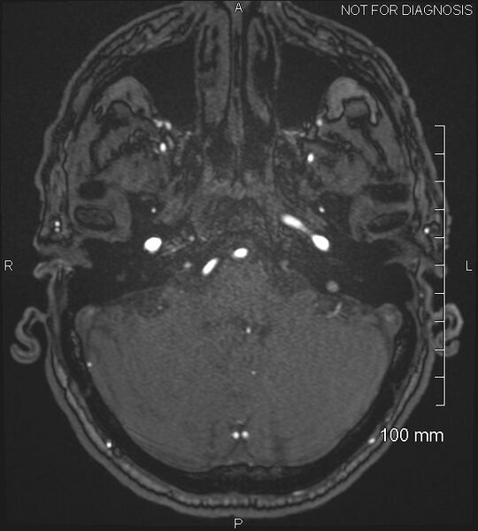 File:Anterior cerebral artery aneurysm (Radiopaedia 80683-94127 Axial MRA 45).jpg
