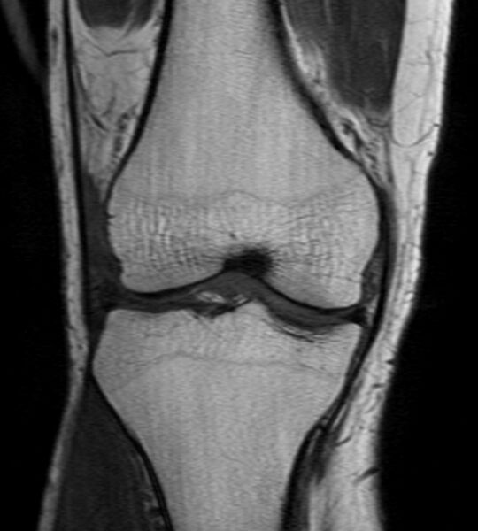 File:Anterior cruciate ligament avulsion injury (Radiopaedia 13134-13169 Coronal T1 1).jpg