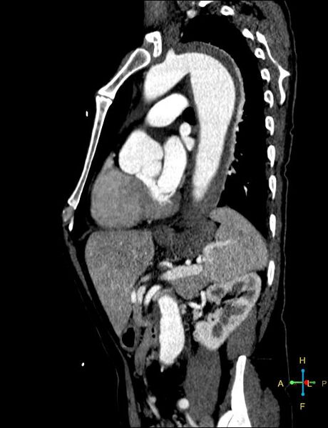File:Aortic aneurysm and penetrating ulcer (Radiopaedia 23590-23704 C 7).jpg