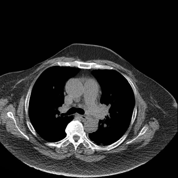 File:Aortic arch false aneurysm (Radiopaedia 14667-14587 Axial non-contrast 20).jpg