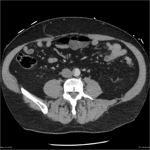 File:Aortic dissection- Stanford A (Radiopaedia 37759-39664 A 124).jpg