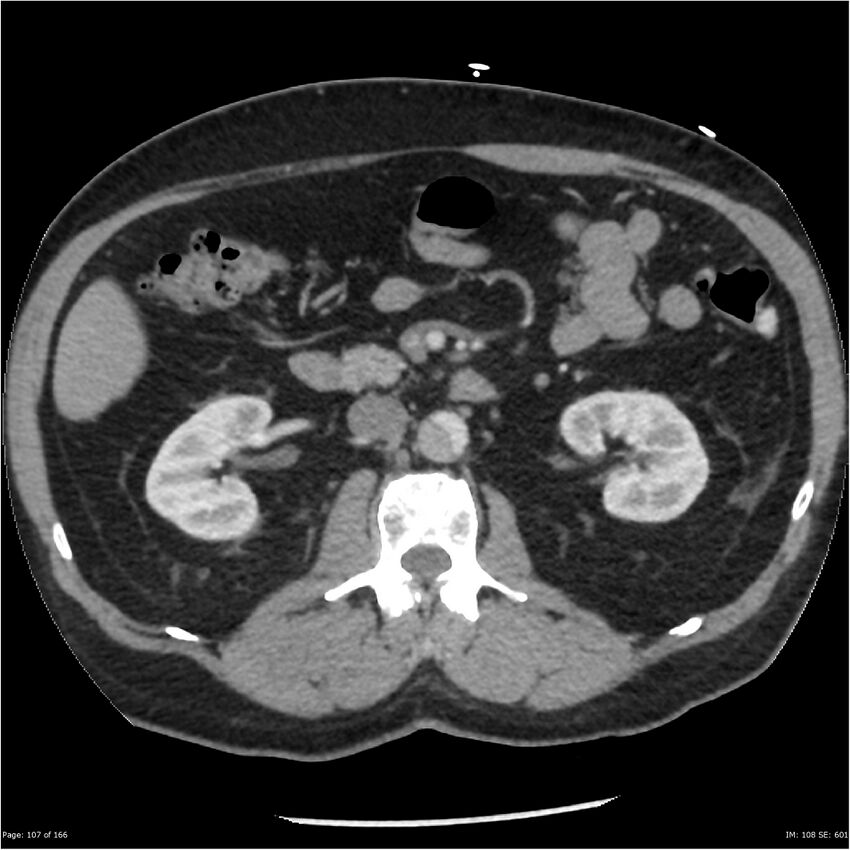 Aortic dissection- Stanford A (Radiopaedia 37759-39664 A 98).jpg