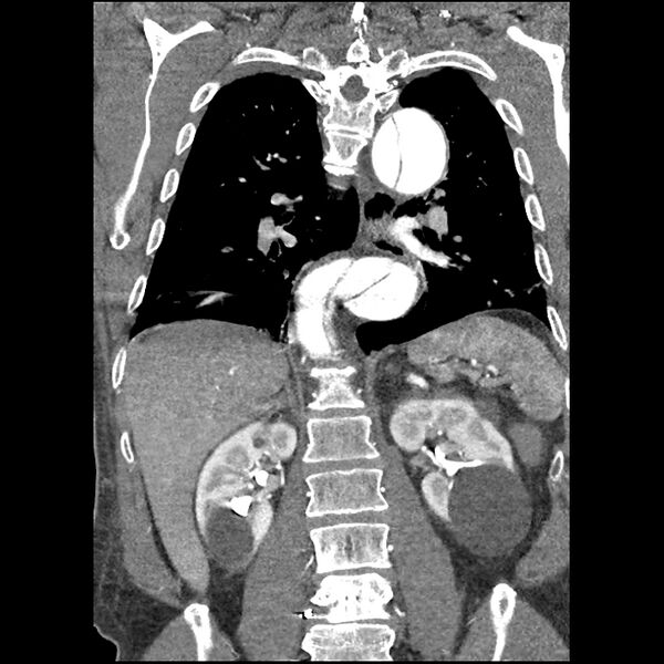 File:Aortic dissection - DeBakey Type I-Stanford A (Radiopaedia 79863-93115 B 26).jpg