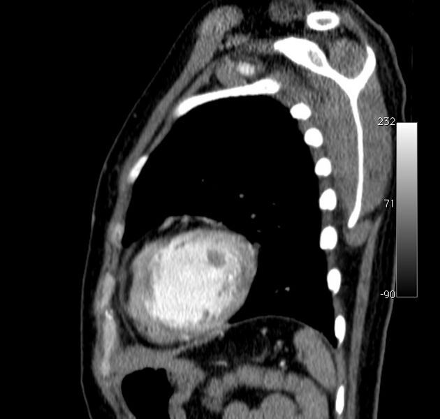 File:Aortic dissection - Stanford type A (Radiopaedia 29247-29659 C 4).jpg