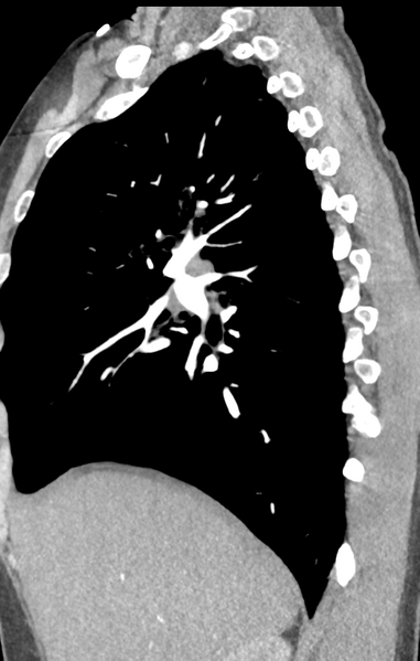 File:Aortic valve non-coronary cusp thrombus (Radiopaedia 55661-62189 C+ arterial phase 45).png