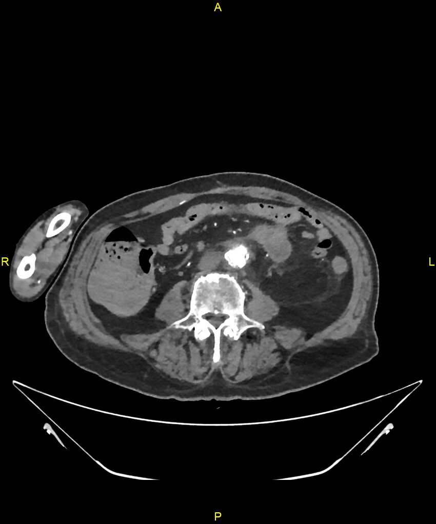 Aortoenteric fistula (Radiopaedia 84308-99603 B 215).jpg