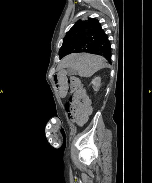 File:Aortoenteric fistula (Radiopaedia 84308-99603 C 73).jpg