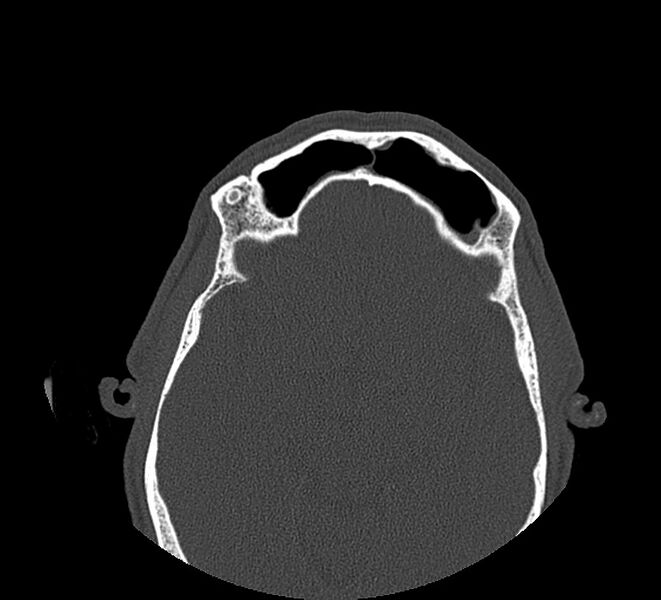 File:Aplastic maxillary sinuses (Radiopaedia 60030-67561 Axial non-contrast 58).jpg