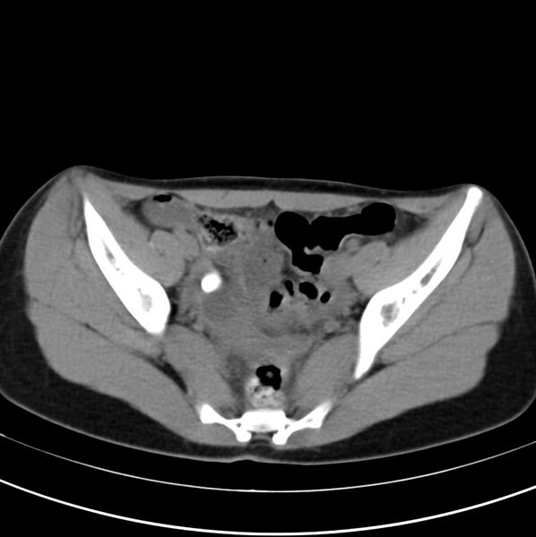 File:Appendicitis and incidental bicornuate uterus (Radiopaedia 22833-22853 Axial non-contrast 38).jpg