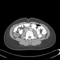 Appendicitis with minimal stranding but appendicolith (Radiopaedia 29035-29397 A 47).jpg