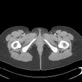 Appendicitis with minimal stranding but appendicolith (Radiopaedia 29035-29397 A 91).jpg