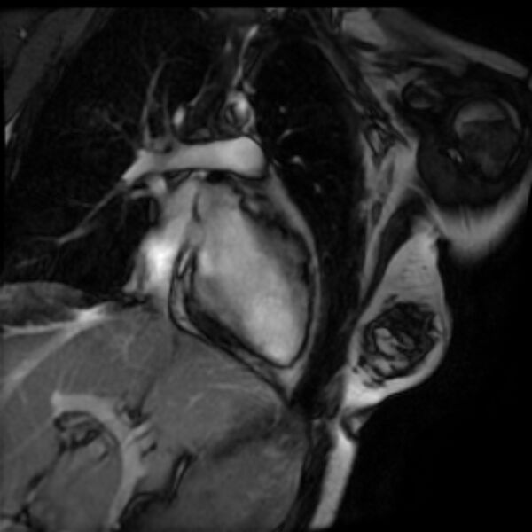File:Arrhythmogenic right ventricular cardiomyopathy (Radiopaedia 87505-103850 2ch (LV) Cine SSFP 1).jpg