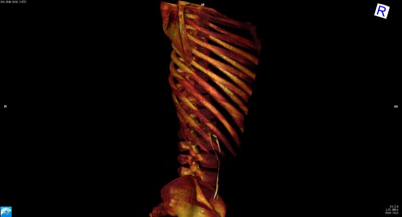 File:Arrow injury to the chest (Radiopaedia 75223-86321 3D bone 33).jpg