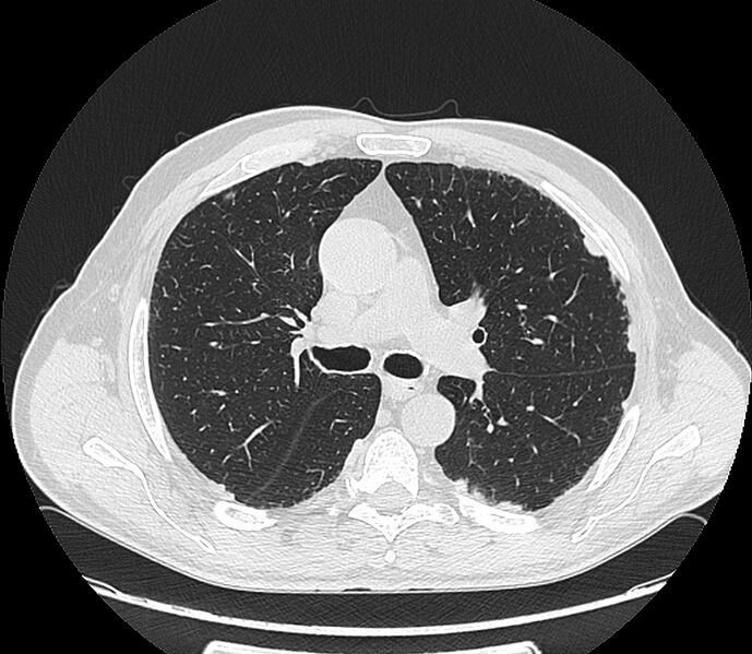 File:Asbestos pleural placques (Radiopaedia 57905-64872 Axial lung window 105).jpg